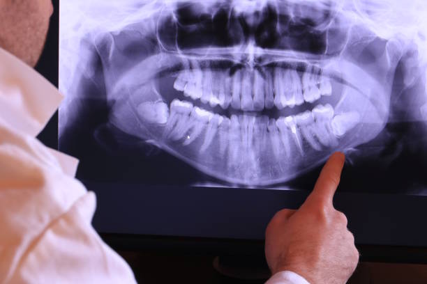 Best Emergency Treatment for Dental Infections or Abscesses in Perris, CA